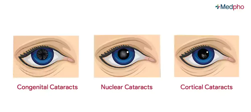 Congenital Cataracts